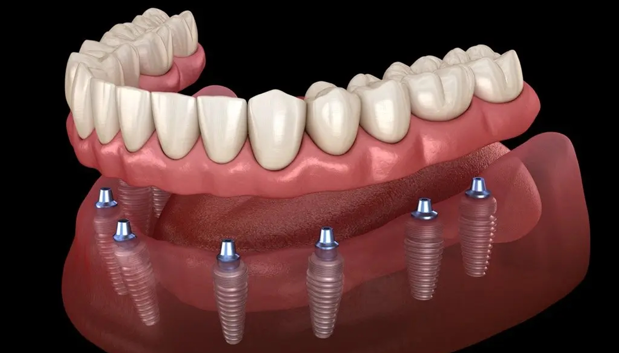 Cosmetic Crowns and Bridges 1 banner_1