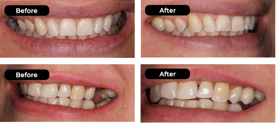 Dental Implants before and after 3