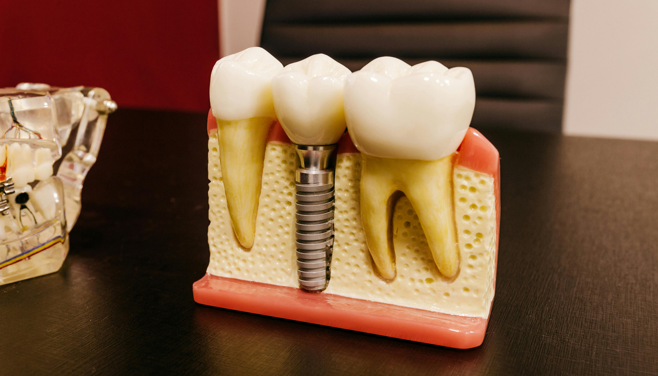 Dental Implants 1 banner_1