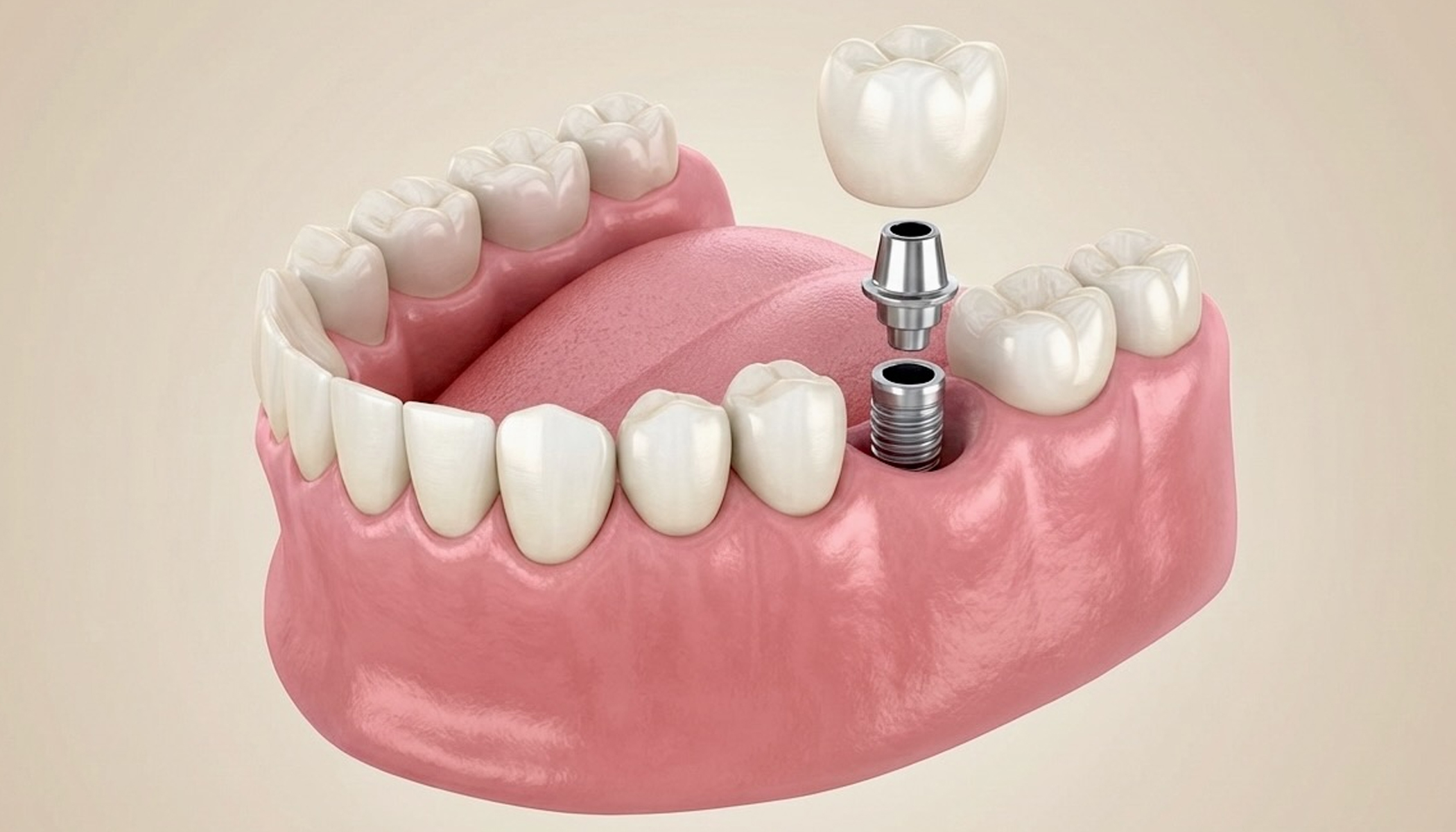 Dental Implants 3 banner_2