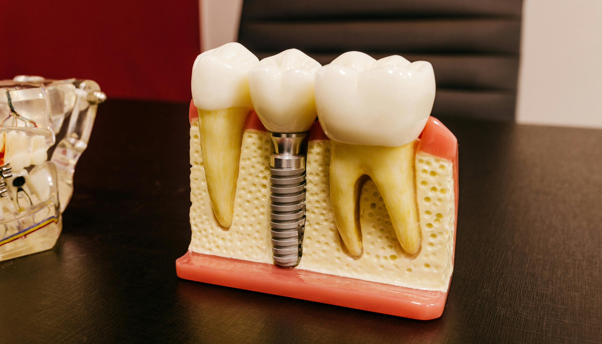 Oral Surgery 2 Dental Implants