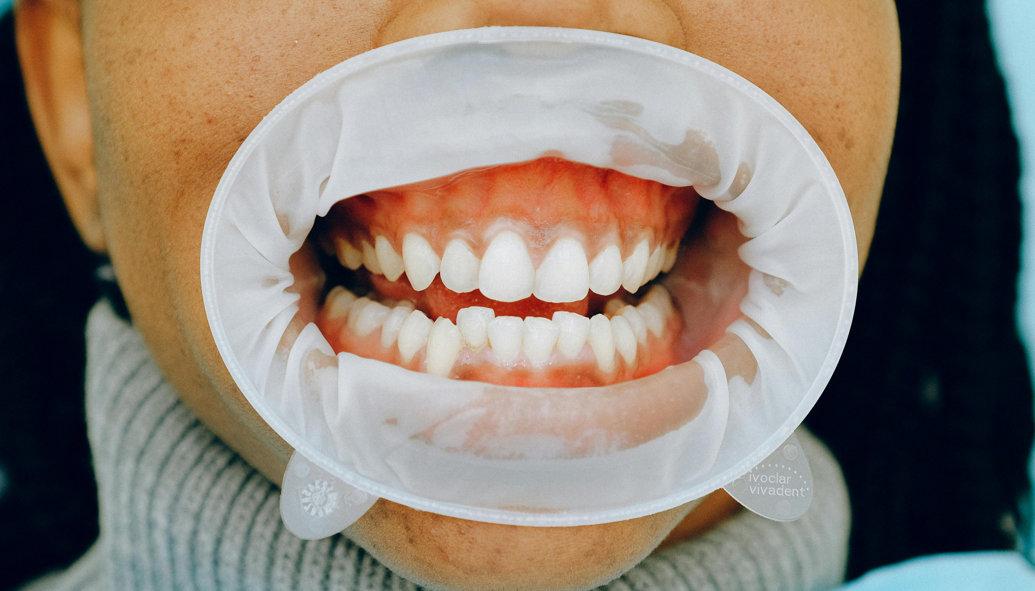 Periodontics 1 Gingivitis — The Early Stage