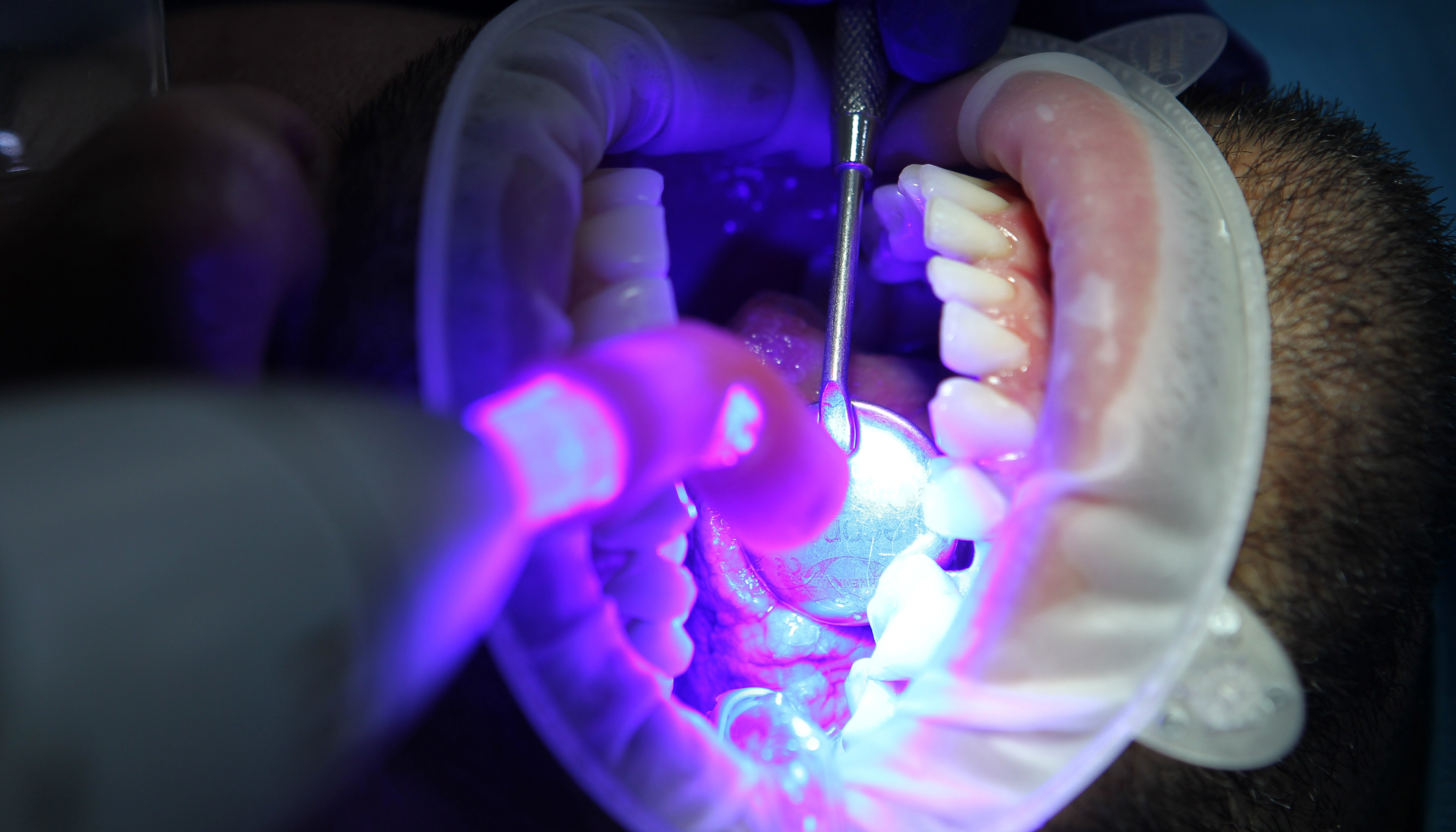 Cosmetic Dentistry 6 Teeth Whitening